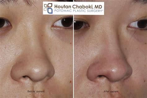 Augmentation Rhinoplasty Without Breaking The Nose