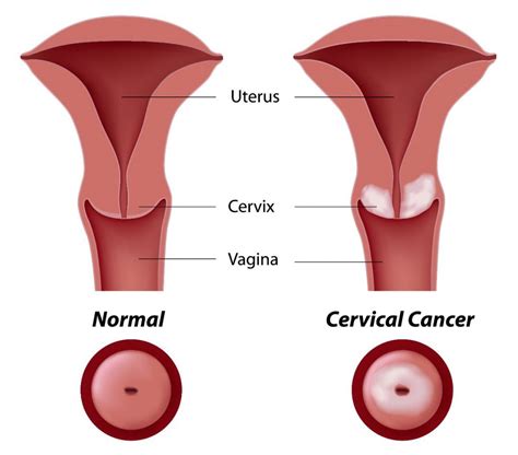 Cervix Cancer Stage 4 2023