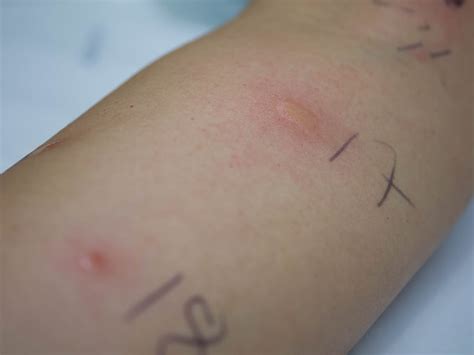 How To Read Allergy Skin Tests All You Need To Know