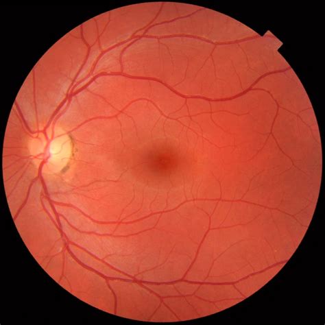 Retinal Exams - New Optix Optometry