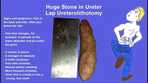 Pin On Urology Surgeries