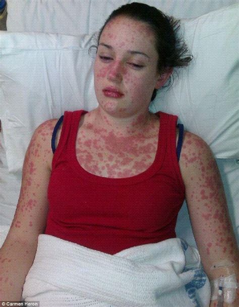 Teenage Girl From Nowra Suffers Horrific Allergic Reaction To