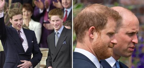 Prince Harry Hair Transplant And His Hair Loss