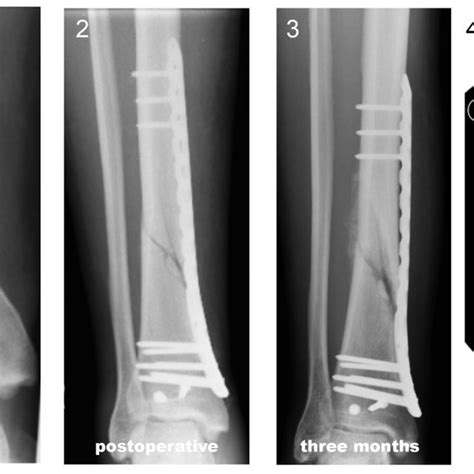 A To 8d Dealing With Distal Tibial Fractures Associated With A