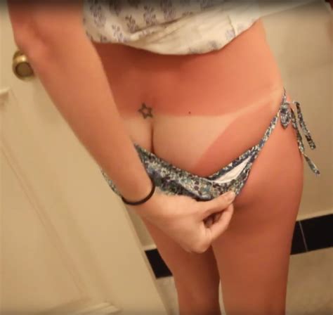 Her Worst Sunburn Porn Photo