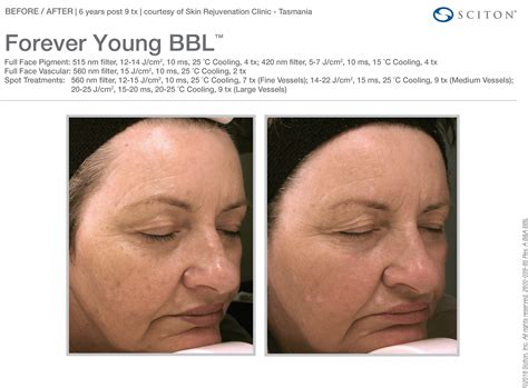 Forever Young Bbl Laser Spa Group