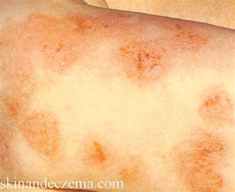 Nummular Eczema Treatment Pictures Photos