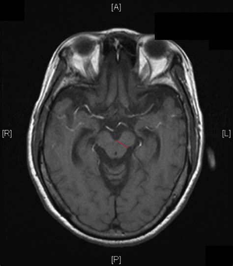 Mickey Mouse Sign Patients Axial Midbrain Diameter At Superior