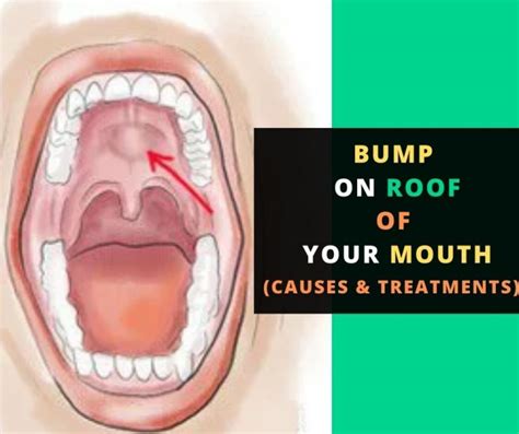 Bump On Roof Of Mouth Causes And Treatments Buildingbeast