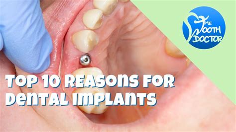 Edmonton Dentist Top 10 Reasons For Dental Implants Youtube
