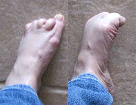 Cramp In Bottom Of Foot Nude Images