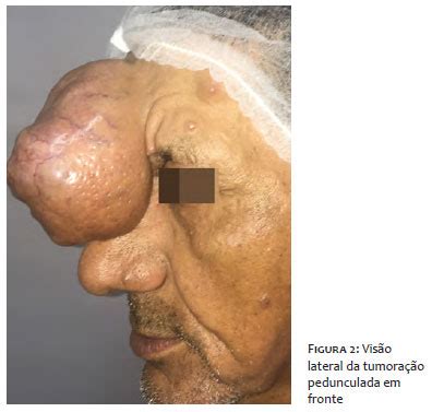 Surgical Cosmetic Dermatology Giant Eccrine Spiradenoma Associated