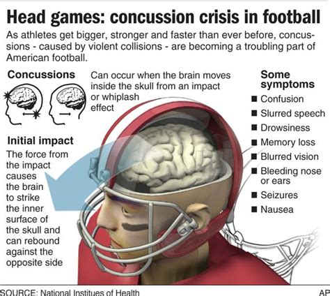 ‘concussion And What You Should Know About Sports And Brain Injuries