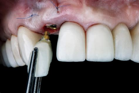 Implantes Dentales Inteligentes Con Nanopart Culas Y Fuentes De Luz