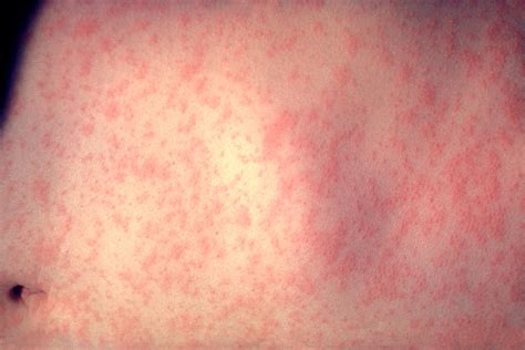 Filemorbillivirus Measles Infection Wikimedia Commons