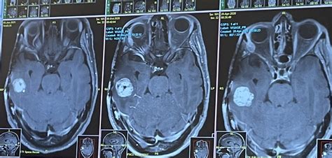 Val Vs Cancer My Battle Against A Rare Brain Tumor Mayo January 2021