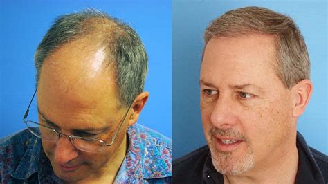 Patient Video Hair Restoration Testimonial Hair Restoration Center Of
