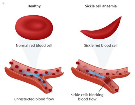 Sickle Cell Anaemia What Is It Symptoms And Treatment Top Doctors