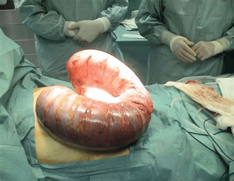 Rules to examine with a colon checker. The sigmoid colon was 60 cm in length | Download ...