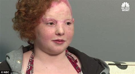 Girl Scalped On Omahaon Carnival Ride Speaks Out Daily Mail Online