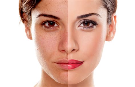 Peel Away Imperfections With Pca Skin Peel National Laser Institute