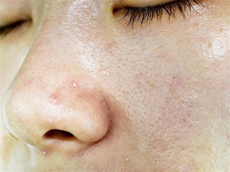 Get Rid Clogged Pores On Nose Squeeze Clean Remedies Causes Of