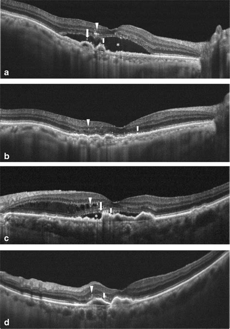 Representative Cases Of Neovascular Age Related Macular Degeneration