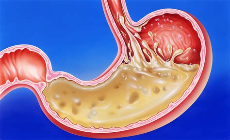 5 Signs You May Have Low Stomach Acid Austin Texas Functional