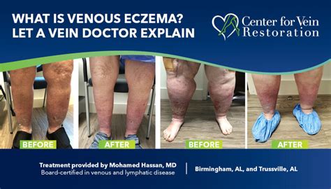 What Is Venous Eczema Let A Vein Doctor Explain