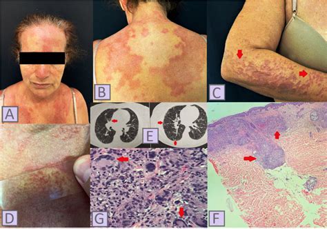 A Erythematous Plaques On The Face And Chest B Erythematous