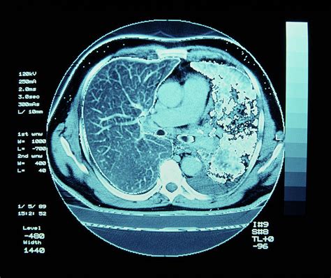 Ct Scan On Chest Showing Lung Cancer Photograph By Simon Fraser Science