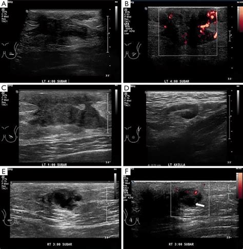 Bilateral Breast Ultrasound Us Images Of Idiopathic Granulomatous