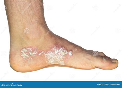 Psoriasis On The Foot Isolated Stock Photo Image Of Plaque Patient