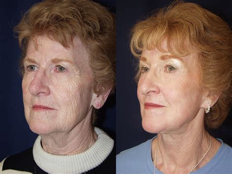 Forehead And Facellift Eyelid Surgery Before And After Age 64