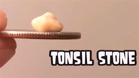 Tonsil Stone Removal Tools Tonsil Stone Removal Pick Youtube