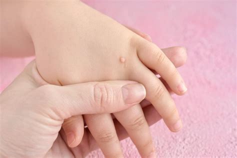 Causes Of Hand Warts