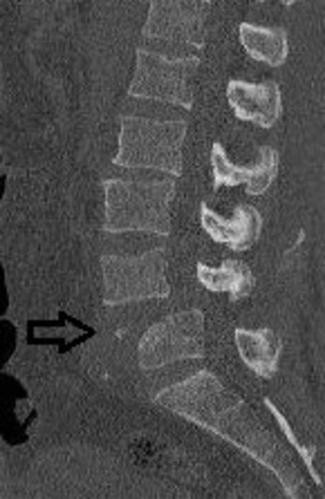 Cureus Traumatic Spondylolisthesis Of The Fourth Lumbar Vertebra Hot