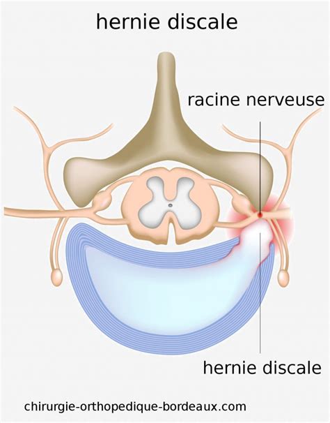 Sympt Me Hernie Discale Tout Ce Que Vous Devez Savoir Pour Comprendre