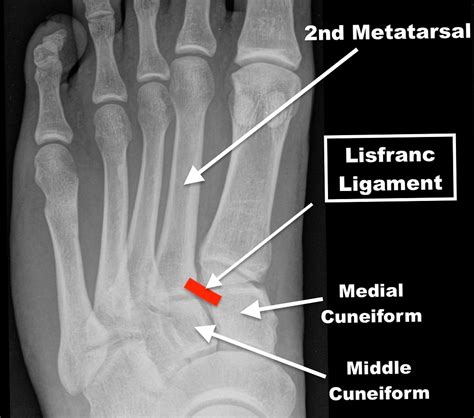 Leblancs Mid Foot Sprain