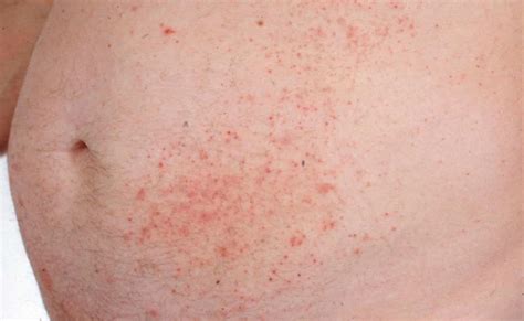 ¿cómo Es La Dermatitis Exfoliativa