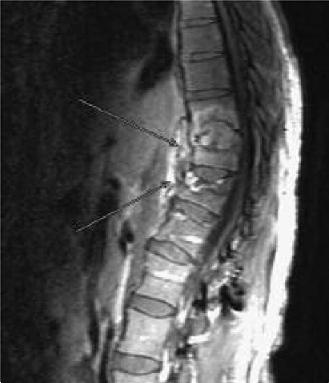 Sagittal T1 Weighted Enhanced Mri Discitis T10 T11 T12 And