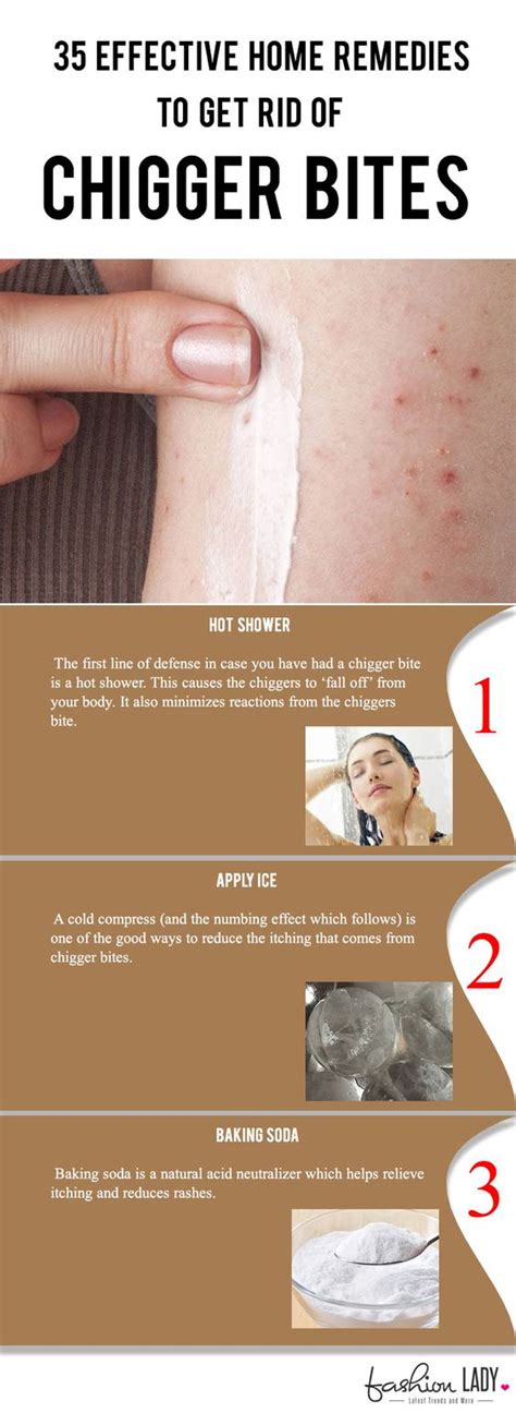35 Effective Home Remedies To Get Rid Of Chigger Bites