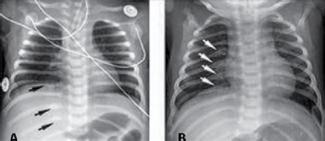 Rib Fractures From Physical Abuse A Frontal Chest Radiograph Show