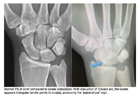 Lunate Dislocation Core Em