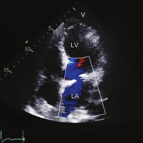 Tee Showing The Mitral Valve And The Lvot The Ruptured Chord Made It