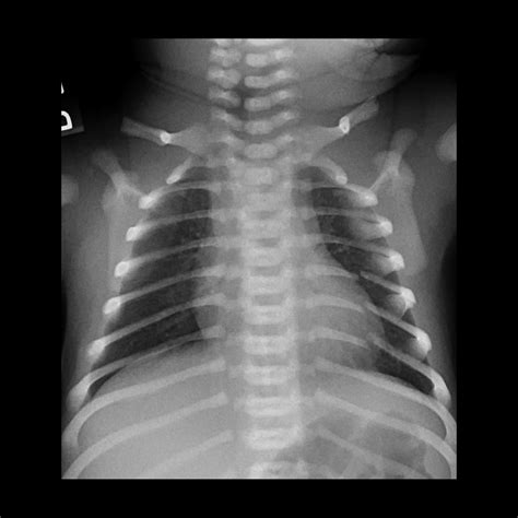 Rib Fractures Pacs