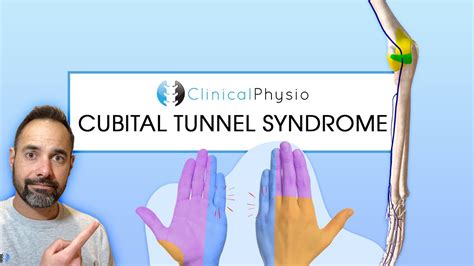 Cubital Tunnel Syndrome Expert Physio Review On Assessment Youtube