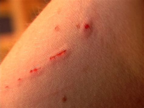 What Are The Signs And Symptoms Of Cat Scratch Disease Storymd