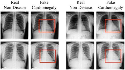 Injection Of Cardiomegaly Red Rectangles Label The Enlarged Heart Download Scientific Diagram