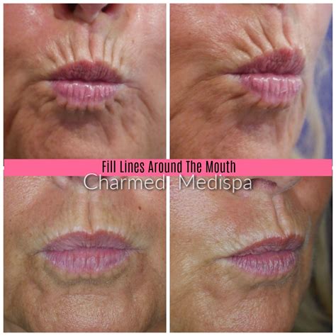 Lip Lines And Creases Around The Mouth Quick Fix Charmed Medispa